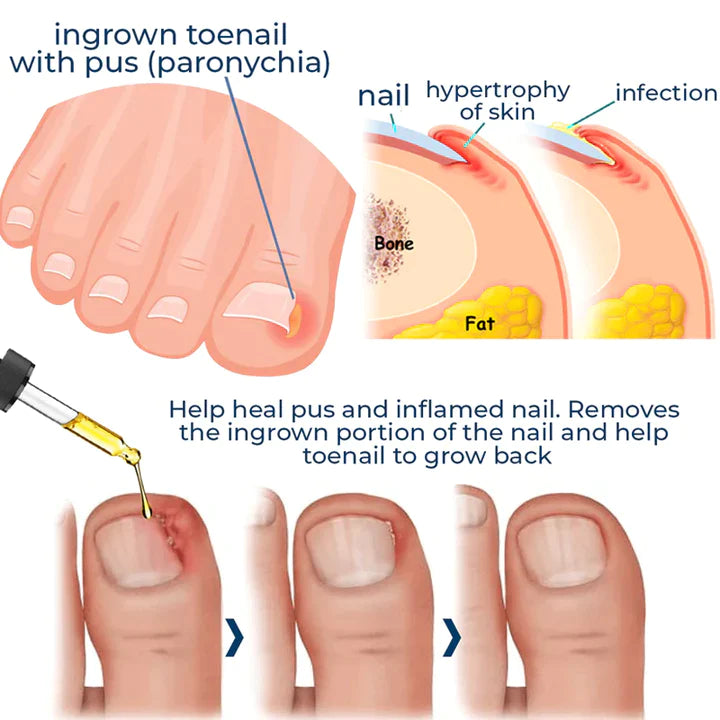 Anti Paronychia Relief Oil & Ingrown Toenail Corrector Fungal Nail & Pain Treatment Drops