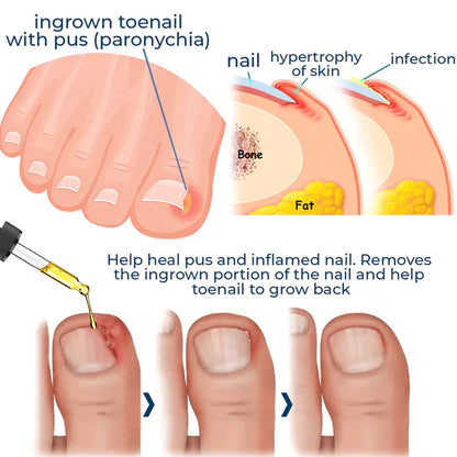 Anti Paronychia Relief Oil & Ingrown Toenail Corrector Fungal Nail & Pain Treatment Drops